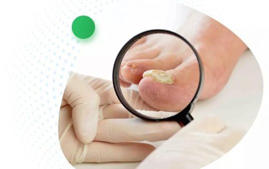 What Is The Best Treatment For Onychomycosis?